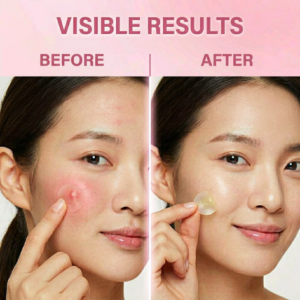 Bulk Hydrocolloid Pimple Patches (100 Pack MOQ) – ODUR Invisible Korean Acne Spot Treatment for Wholesale & Retail